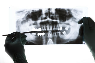 Dr. Kureghian | Northridge, CA Dentist | Dental X-Rays