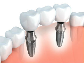 Dr. Kureghian | Northridge, CA Dentist | Dental Implants