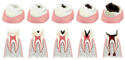 Dr. Kureghian | Northridge, CA Dentist | Root Canal Therapy