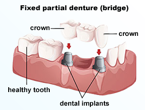 Dr. Kureghian | Northridge, CA Dentist | Crowns & Bridges