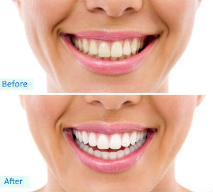 Dr. Kureghian | Northridge, CA Dentist | Teeth Whitening
