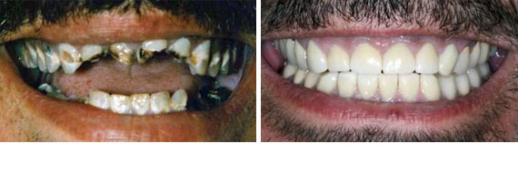 Before & After - Narbeh Kureghian, DMD