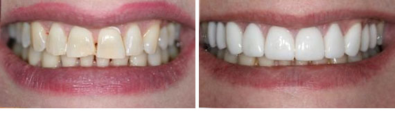 Before & After - Narbeh Kureghian, DMD