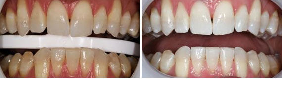 Before & After - Narbeh Kureghian, DMD